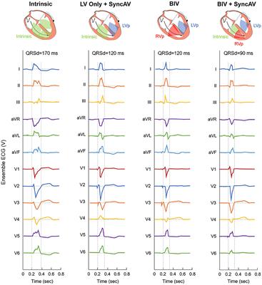 Improvement of LV Reverse Remodeling Using Dynamic Programming of Fusion-Optimized Atrioventricular Intervals in Cardiac Resynchronization Therapy